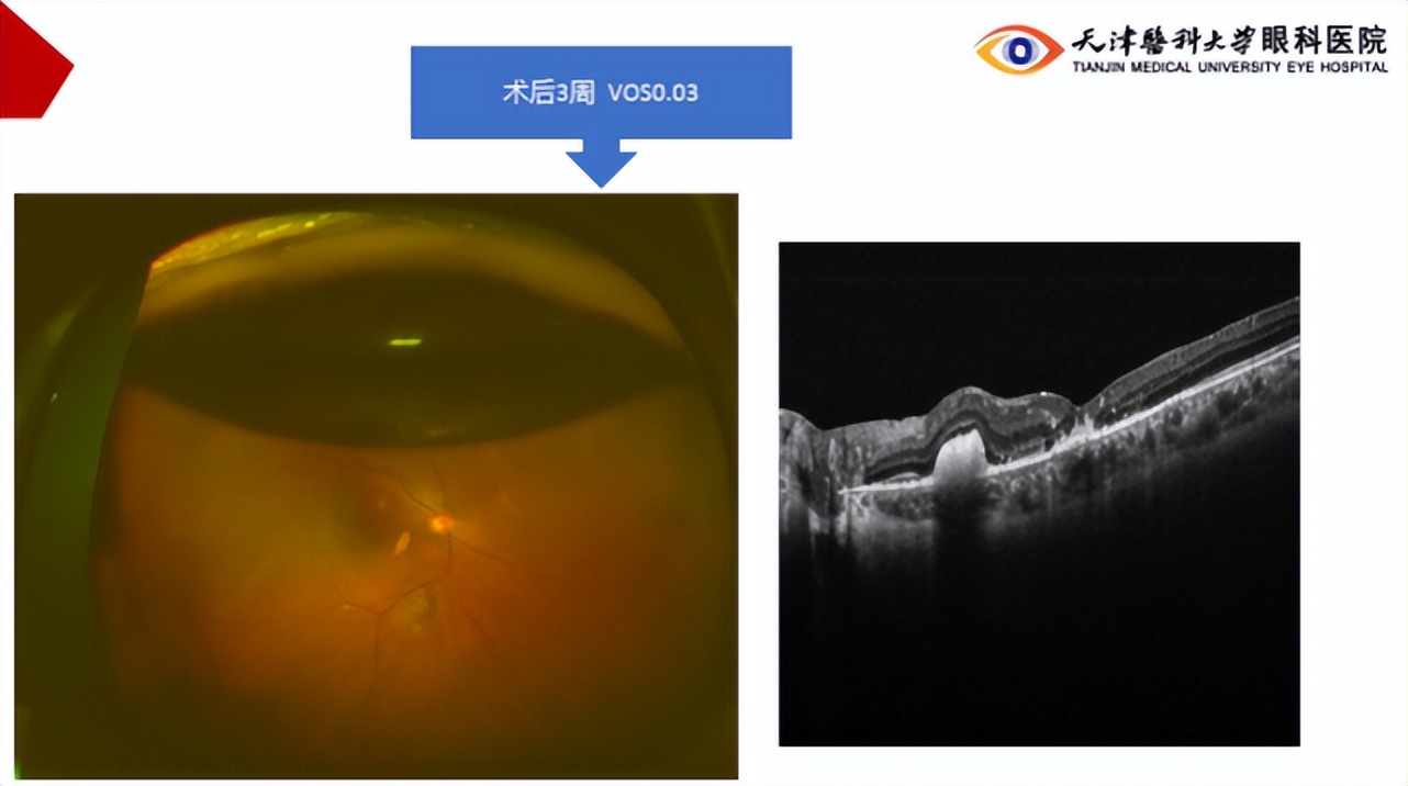李筱荣教授,天津医科大学眼科医院李筱荣