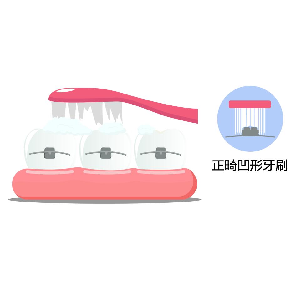 牙齿矫正后变黄怎么变白,牙齿矫正后牙齿变黄怎么回事