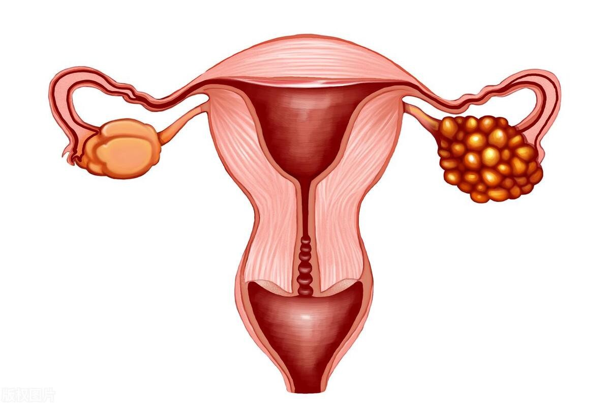 女性为什么容易长子宫肌瘤呢？医生：尽量避免3个行为，别忽视