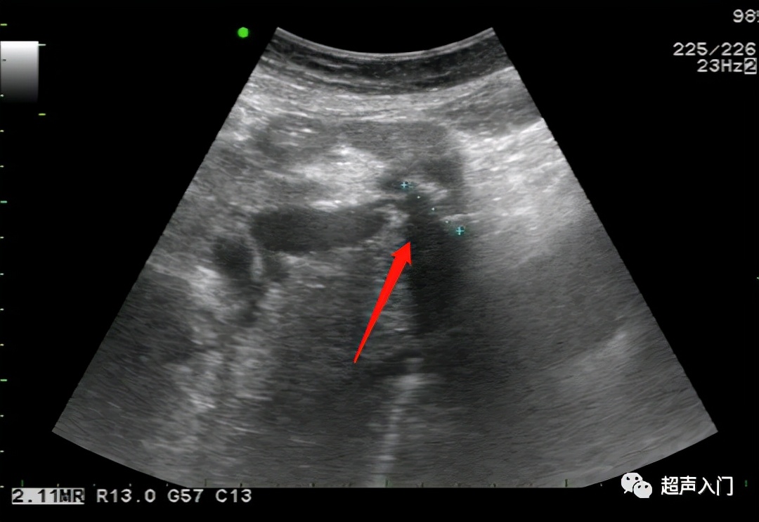 超声学自己能学吗,超声初学者有何窍门