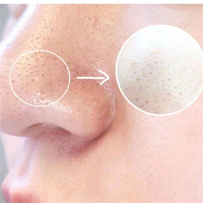 去鼻子黑头粉刺的过程,镊子去除鼻子上的黑头