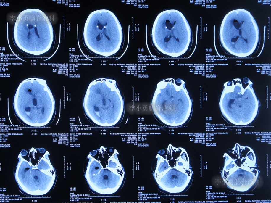 脑积水三脑室造瘘多久能恢复,脑囊虫手术后脑积水