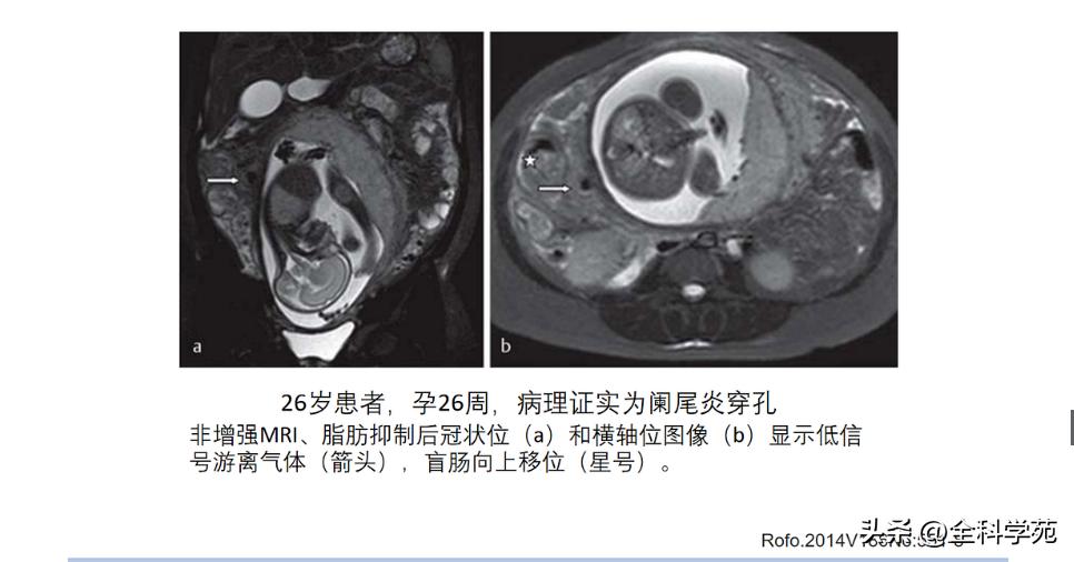 阑尾炎的讲解,关于阑尾炎的讨论总结