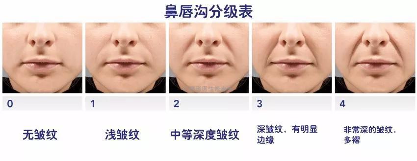 小拉皮加填充法令纹做好休息多久,法令纹严重是做拉皮还是做填充好