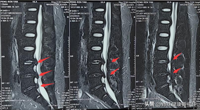 腰椎盘突出臀骨与大腿连接处疼痛,腰间盘突出臀部疼痛脚麻怎么治疗