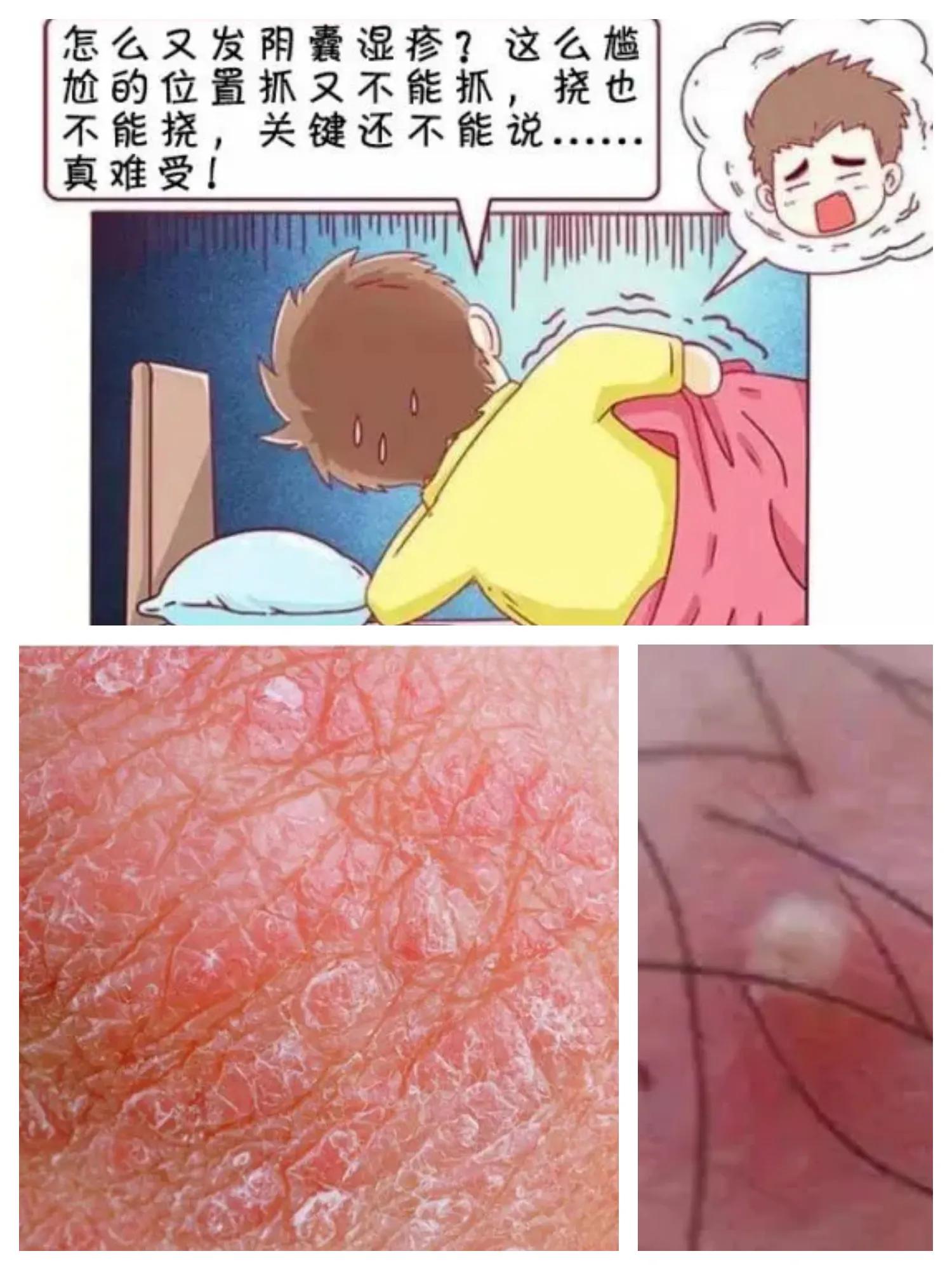 水疱型湿疹中药治疗,湿疹如何治疗发痒裂口