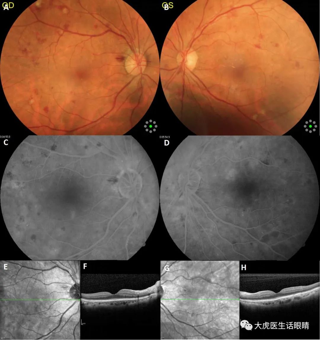 放射性视神经病变,放射性脑炎影像表现