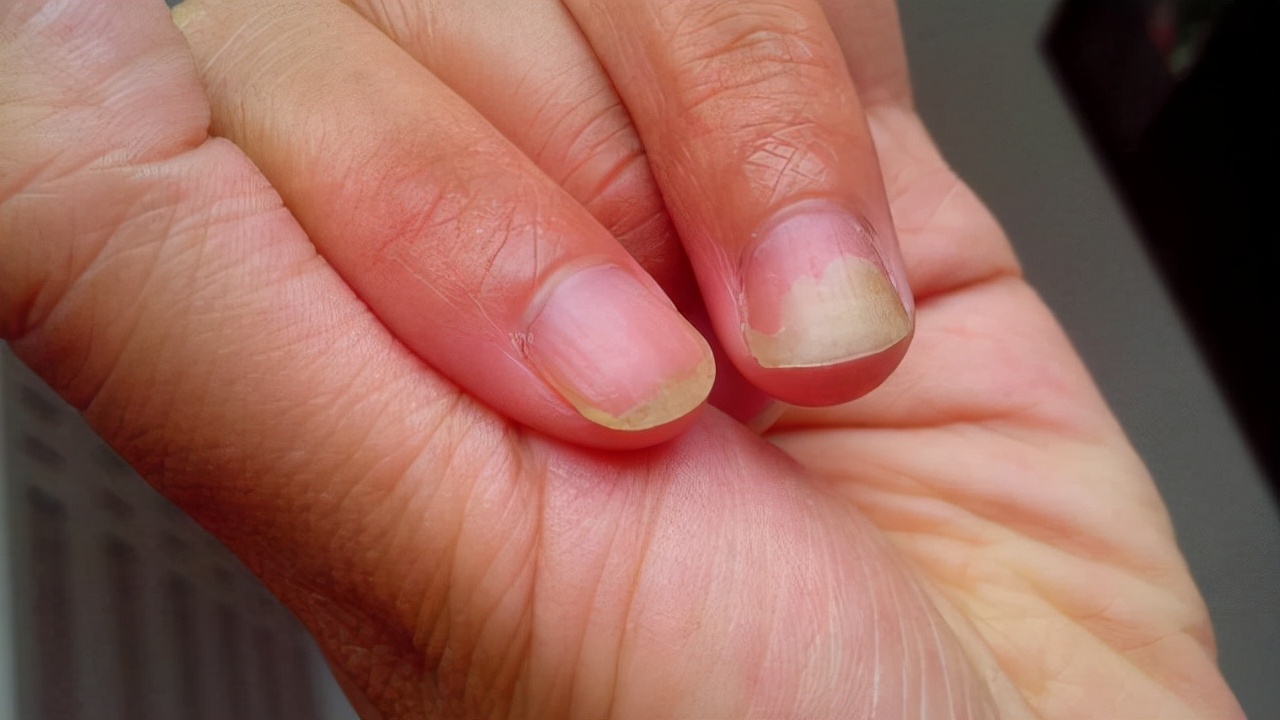 十岁孩子指甲上有竖纹是怎么回事,手指甲出现竖纹是身体哪里的原因