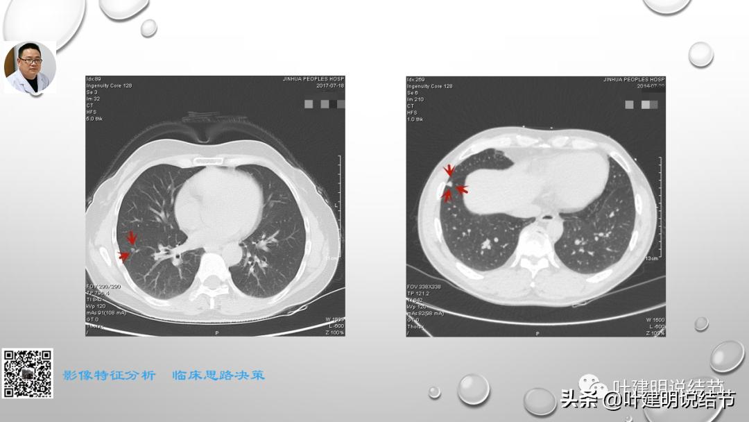在《一脉阳光》呼吸影像诊断专题培训班上的讲课PPT（第一部分）