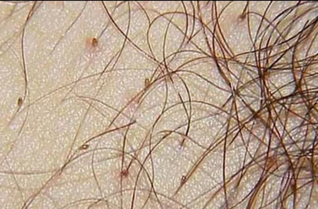 阴虱为何很少见了,阴虱为什么不叫阳虱