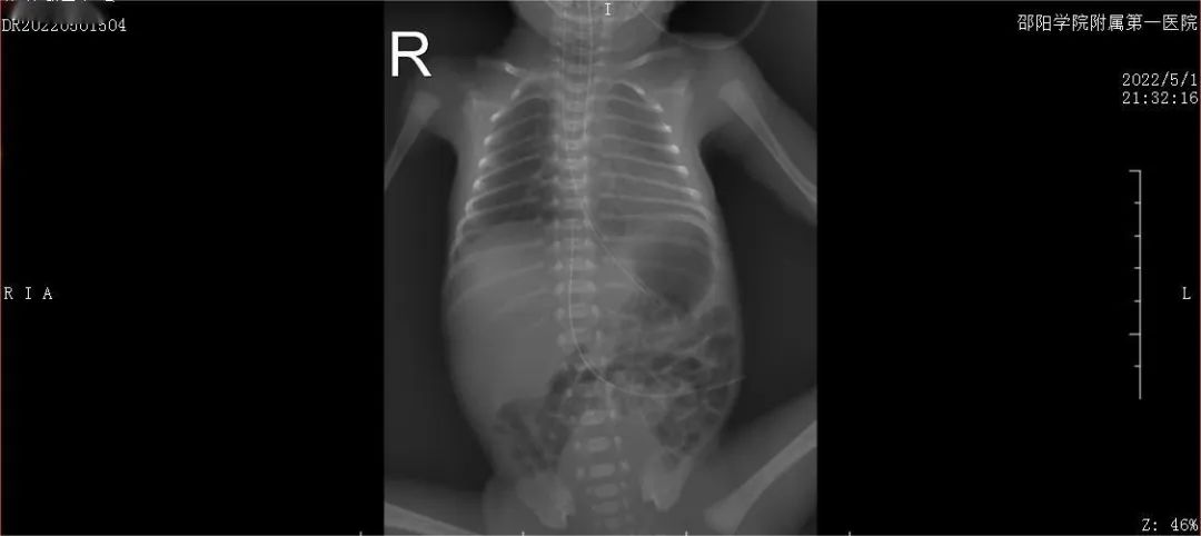 极低出生体重儿抢救新闻,一例极低体重早产儿的个案护理