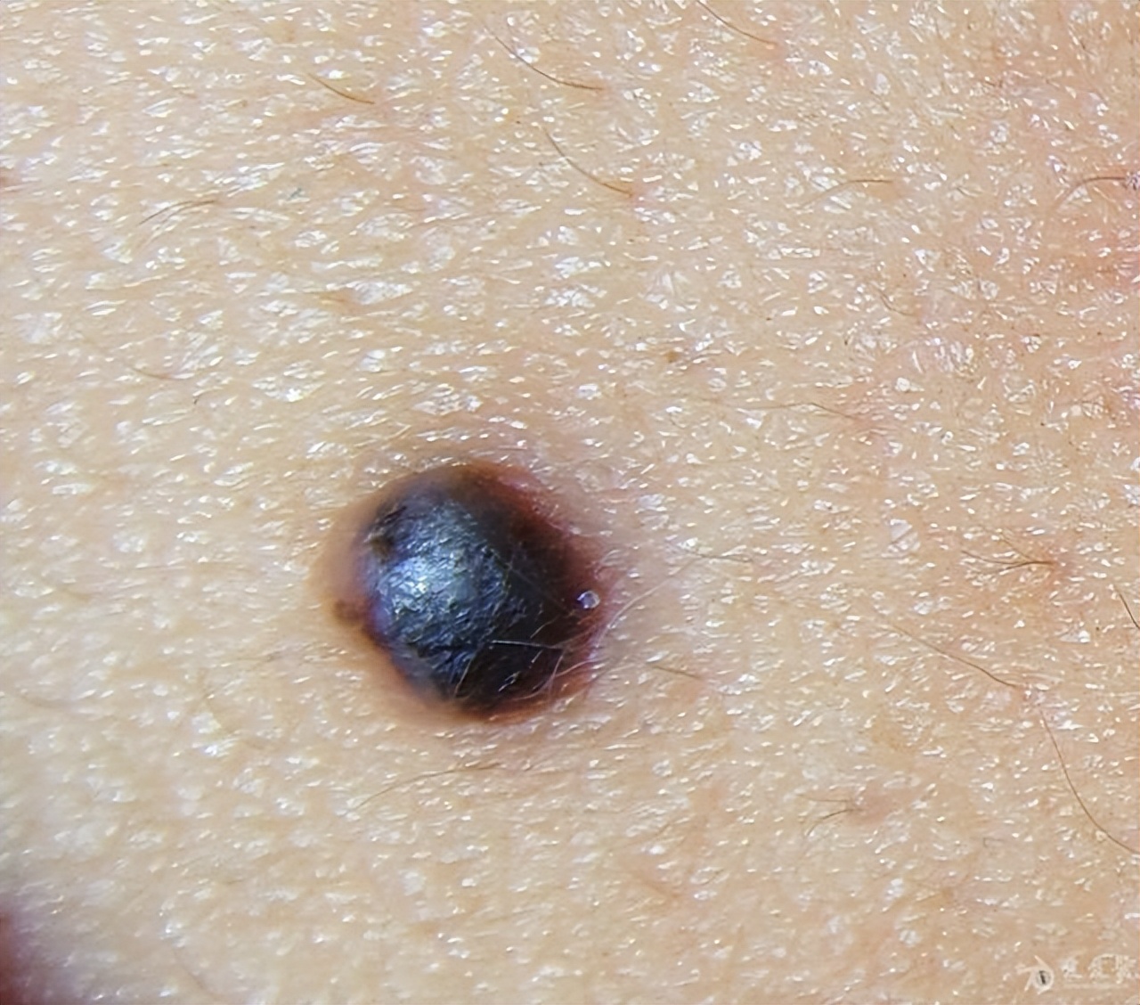 2010年河北行唐，儿子患病身长“巨型黑痣”，母亲为救子割皮移植