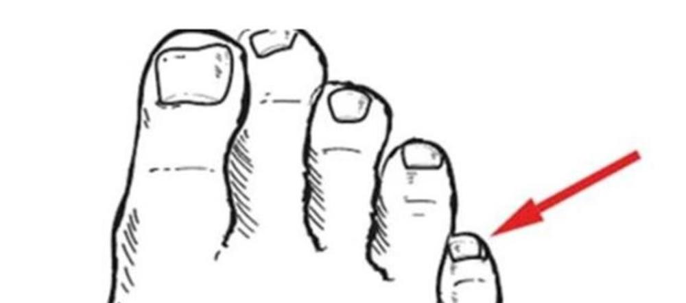 小脚趾甲分成两瓣的人怎么了,小脚趾甲长成两瓣