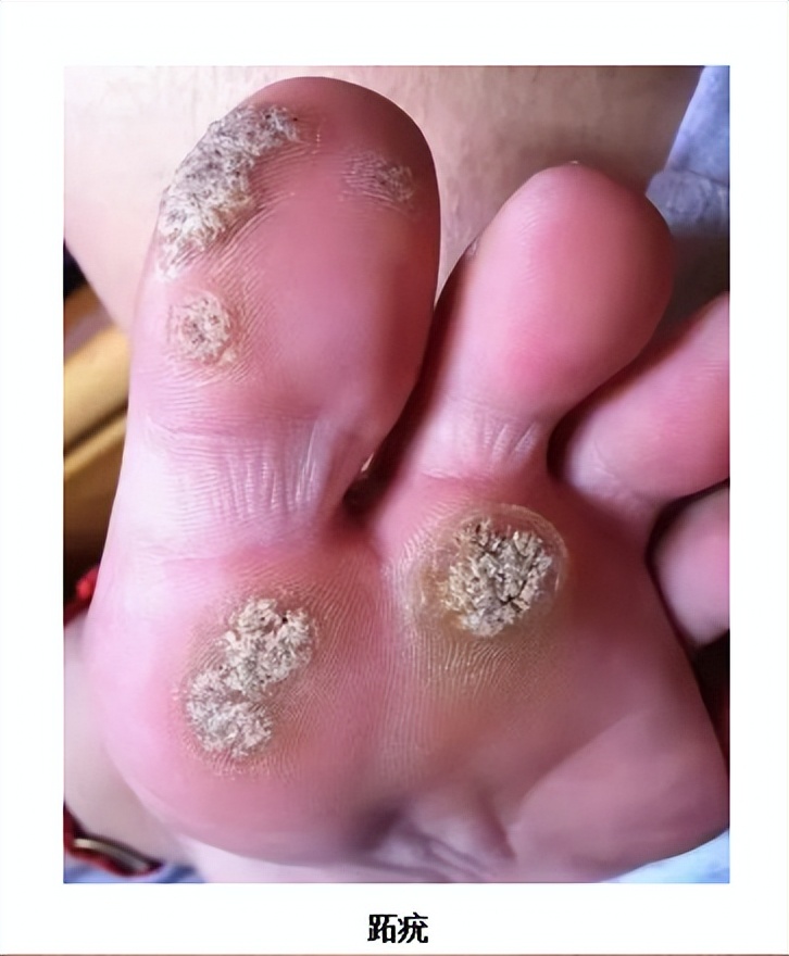 脚上长跖疣和鸡眼有什么区别,脚底透明凸起是鸡眼还是跖疣