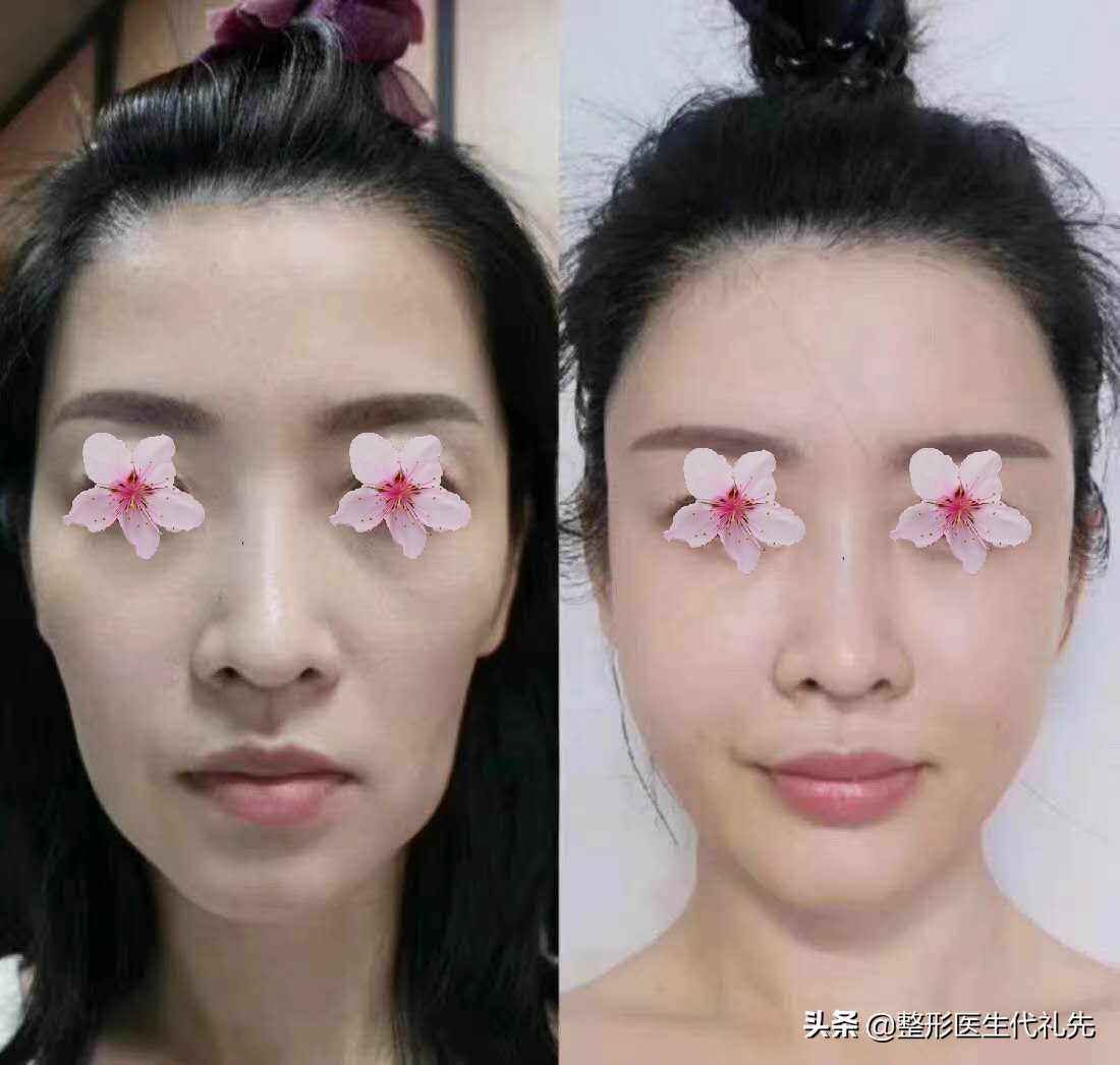 面部凹陷一定要医美来改善吗,脸轻微下垂该怎么整形修复