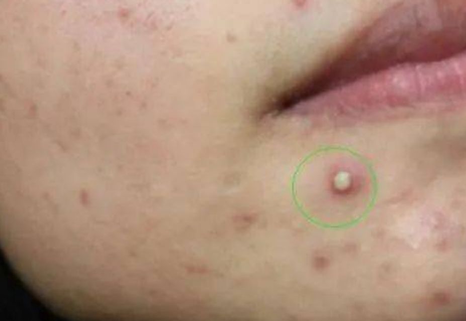 痘痘里面白色的是什么,显微镜下痘痘里面白色的米粒