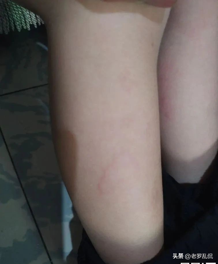 宝宝雾化护士用错了药,护士给小孩雾化放错药怎么办