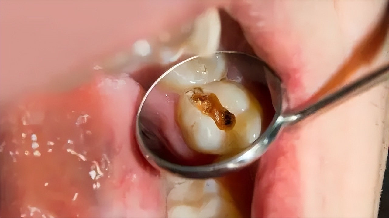 补过的牙齿一碰就疼,补过的牙齿咬硬的东西会疼