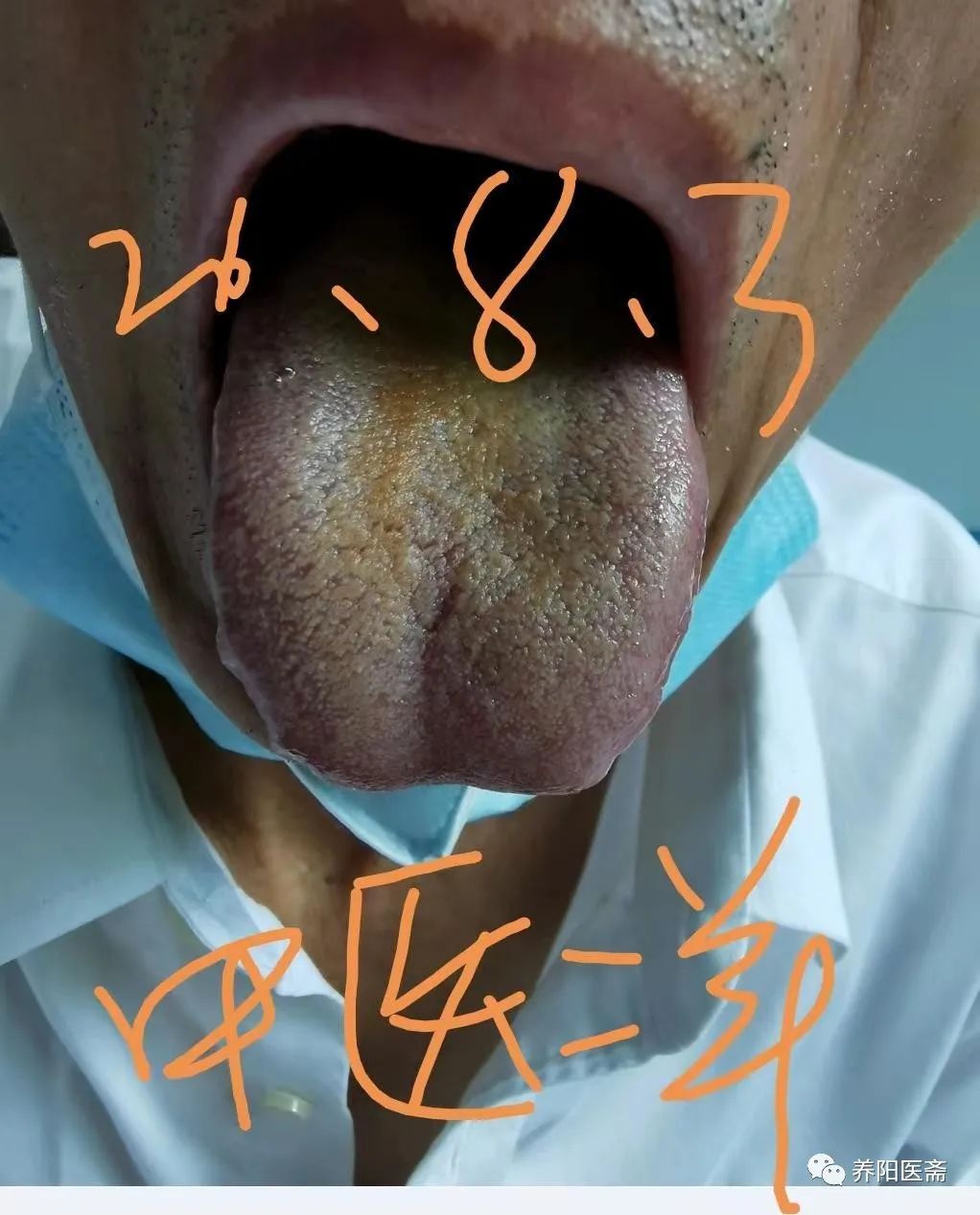 半夏泻心汤治幽门螺杆菌胃炎40例,半夏泻心汤治肝胆湿热兼胃炎医案