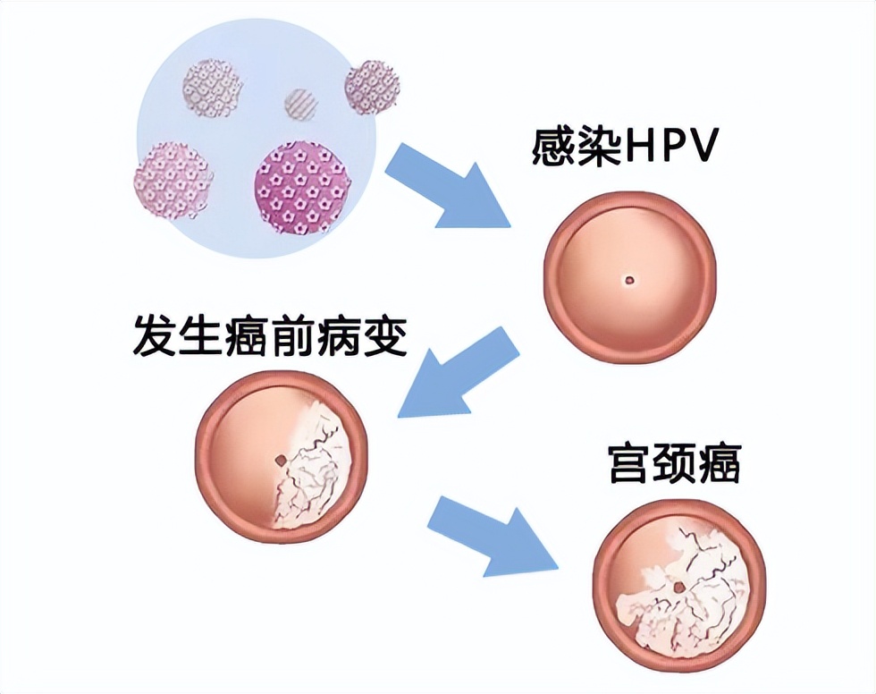 打了hpv疫苗还需要做宫颈癌筛查吗,宫颈癌疫苗是预防hpv的吗