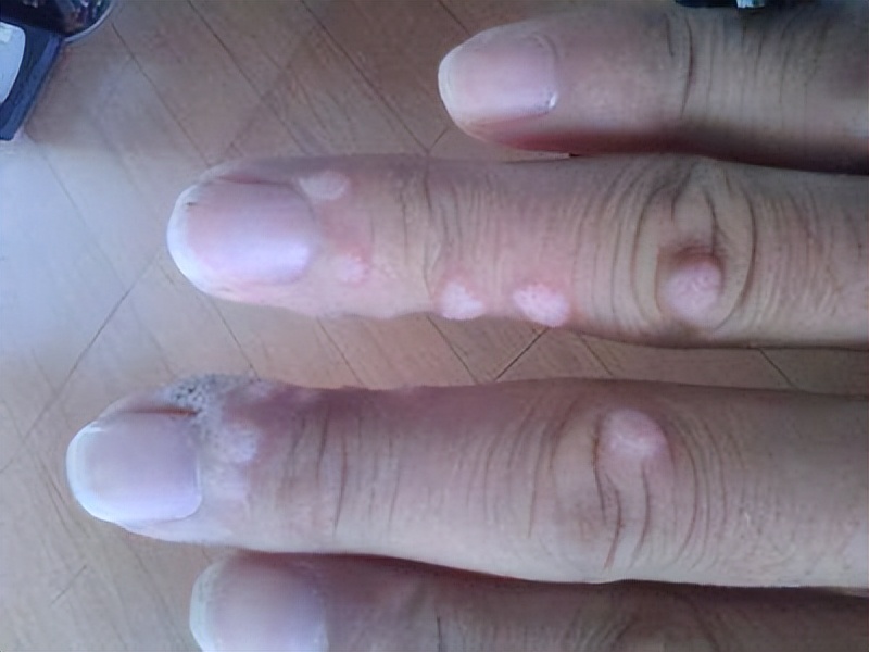 谈谈扁平疣的治疗,关于扁平疣内容