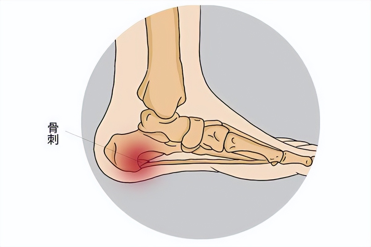 脚后跟疼并痒预示三种病,脚后跟经常疼是什么原因怎样治疗