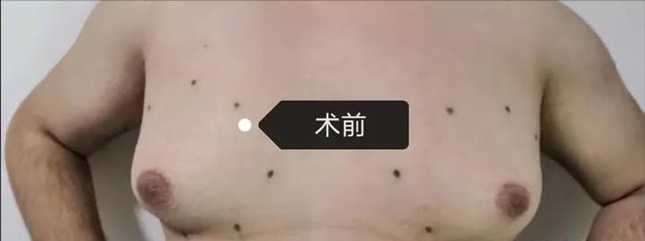 男生胸部太大的原因,男生的胸部大的原因