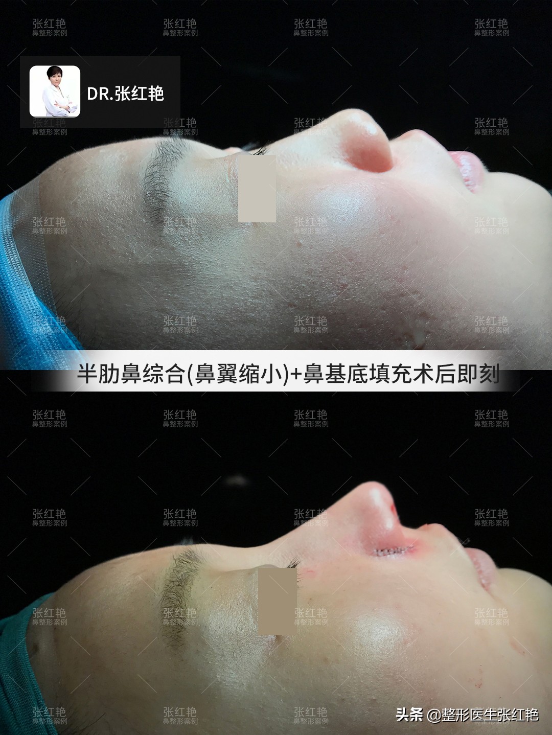 鼻子整形前后真实案例,鼻整形术中的鼻孔之美