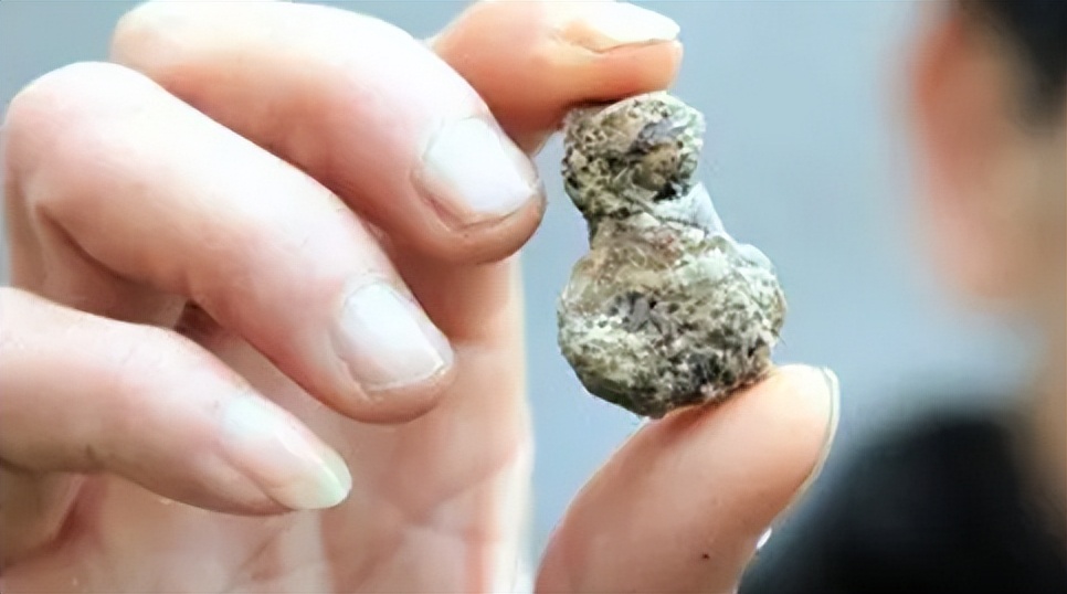 肾结石引起的高血压怎么办,肾结石和高血压有关系吗