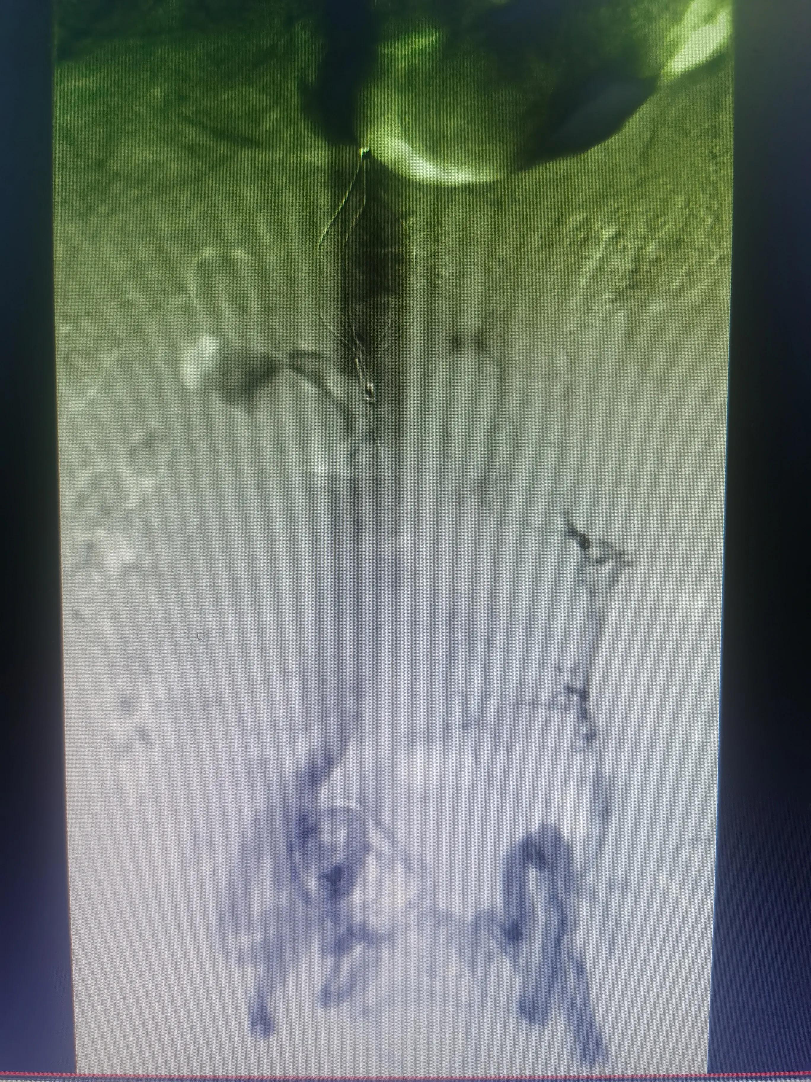 一到下午就腿肿什么原因怎么治疗,腿肿是什么病的前兆怎么治疗