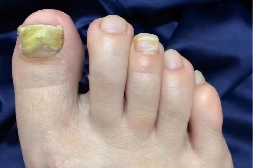 灰指甲治愈心得分享,分享自己根治灰指甲