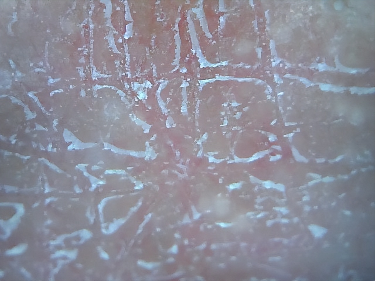 脸上起皮了是怎么回事,脸上起皮是什么原因怎么办