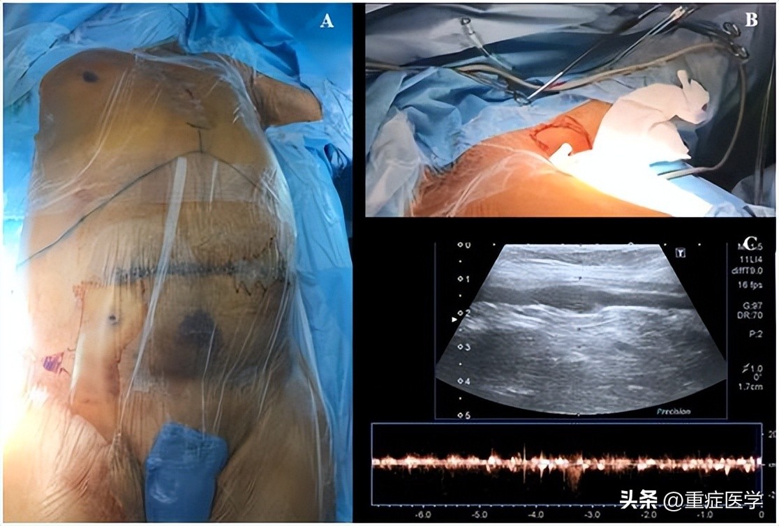 腋静脉穿刺技巧ppt,新生儿腋静脉穿刺技巧视频