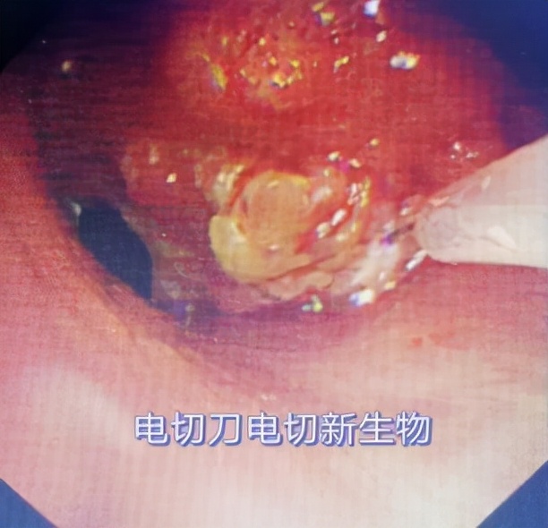 哈医大一院气管镜,哈医大群力呼吸内科