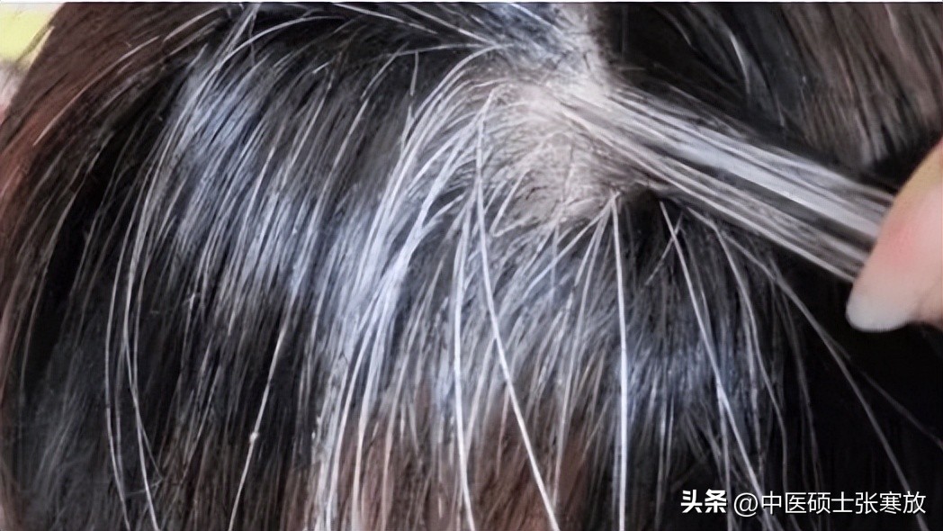 肝肾两虚型白发中药,脾胃虚弱脱发的方子