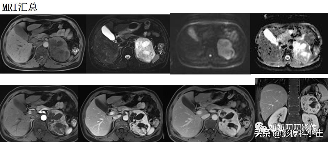 肾上腺疾病的诊断思路,肾上腺可能出现的病症有哪些