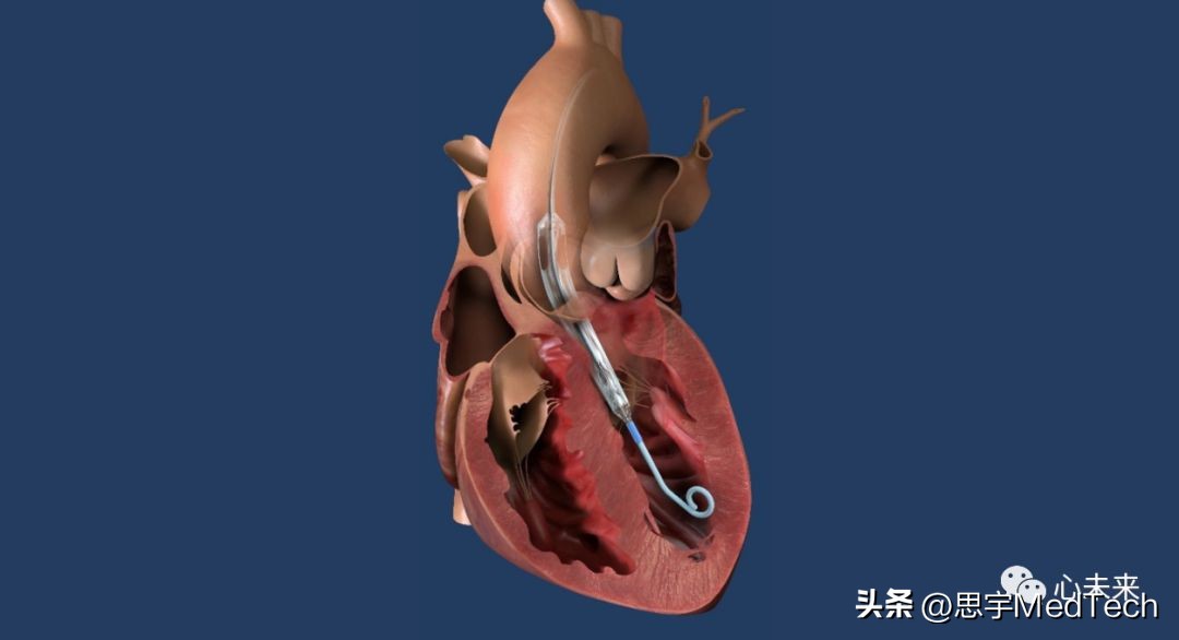 强生投诉,强生人工心脏