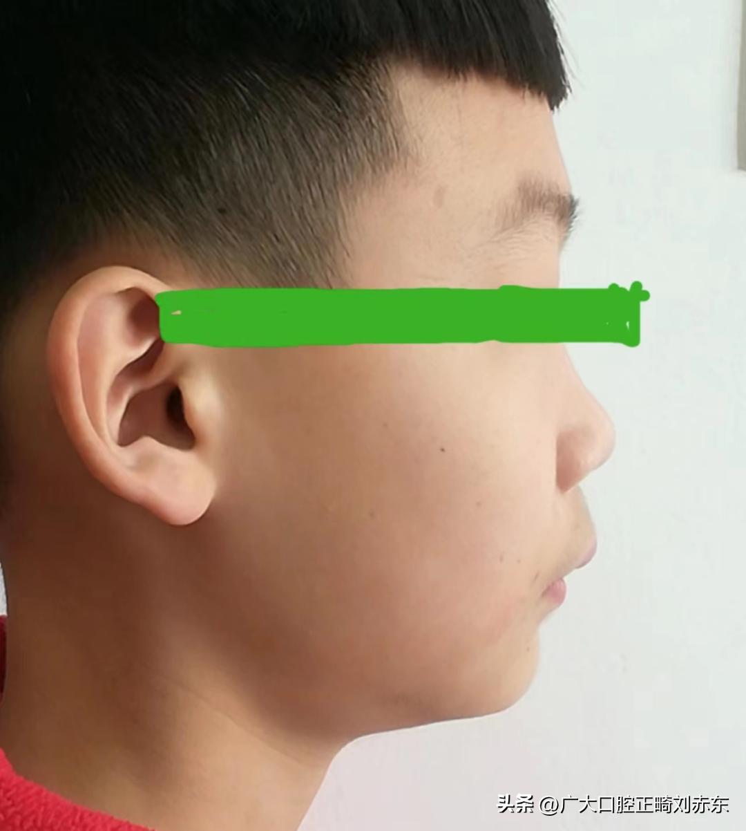 成年以后再矫牙？专家：太迟了，下巴后缩最佳治疗时间是这个时候