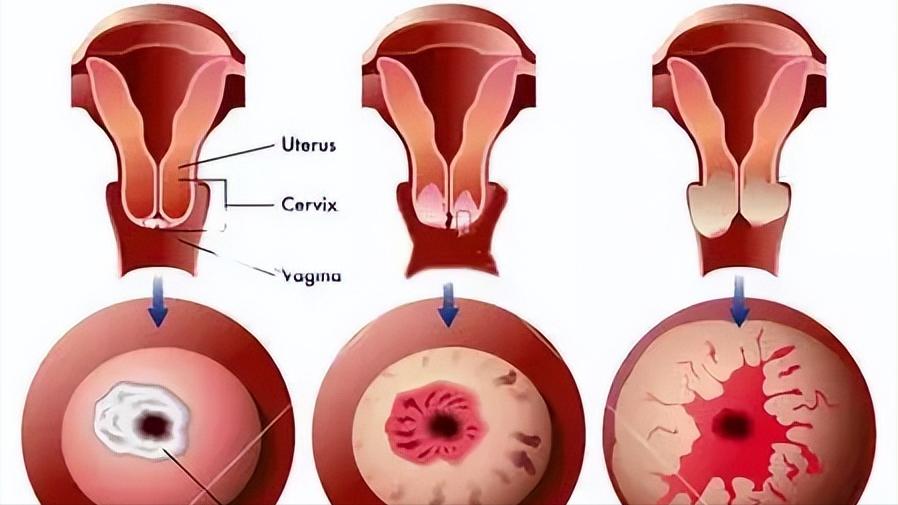 感染hpv患宫颈癌的几率大吗,感染了hpv一定会得宫颈癌