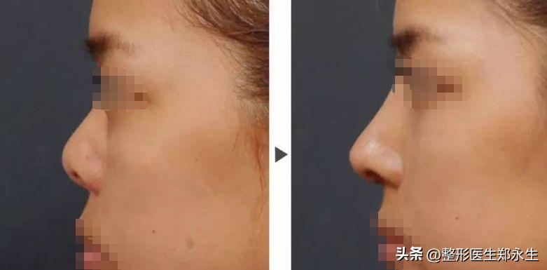 女子花7000去美容不料整成红鼻子,女子花7万整容做鼻子