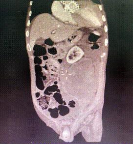 病例回顾与分享,腹膜后血肿介入治疗
