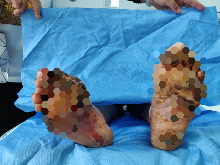 特色中西医结合，助力天山上打“飞的”来渝的“糖足”患者康复