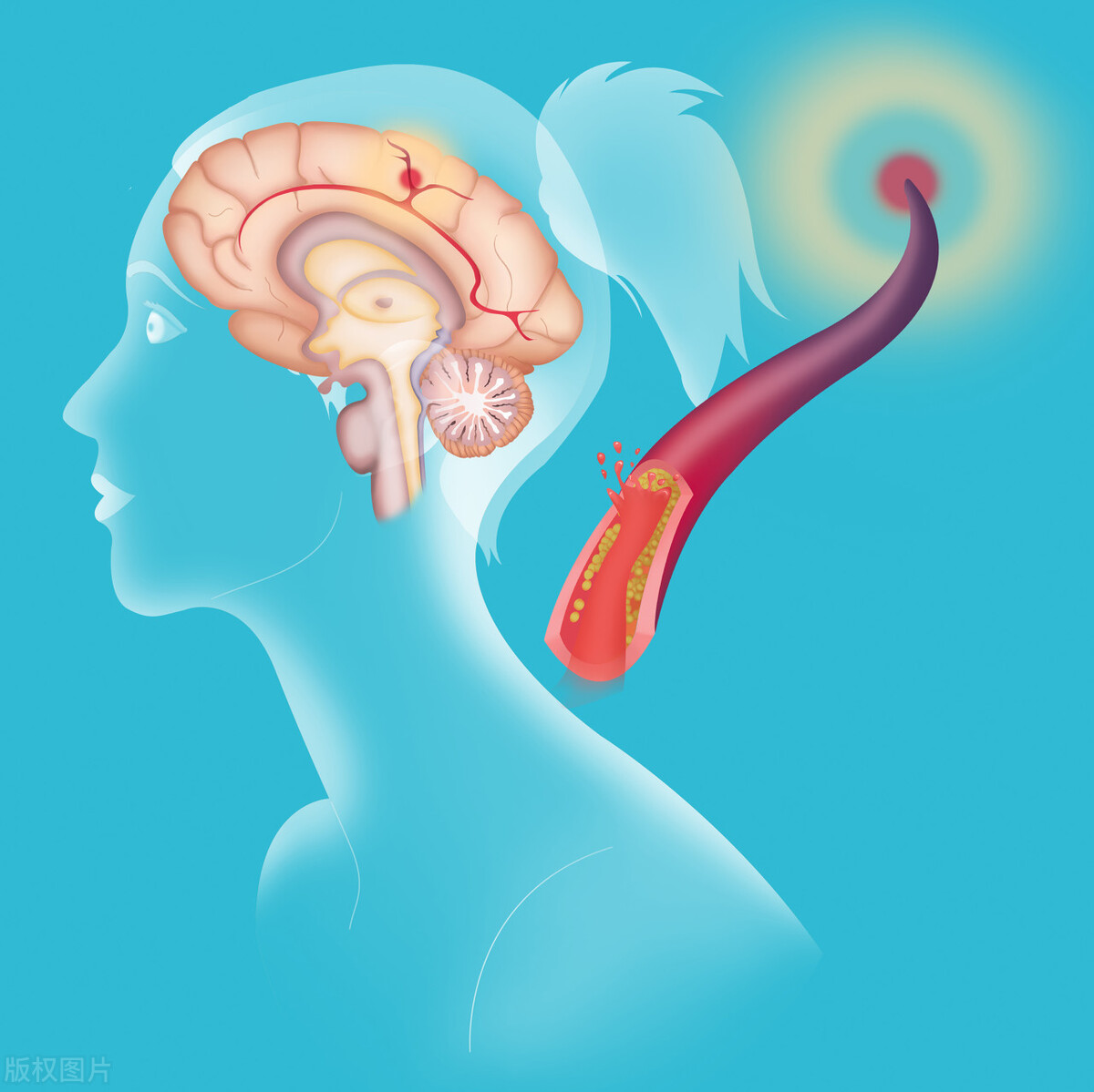 脑部血管堵塞引起的脑梗,得了脑梗有血管堵了能保守治疗吗