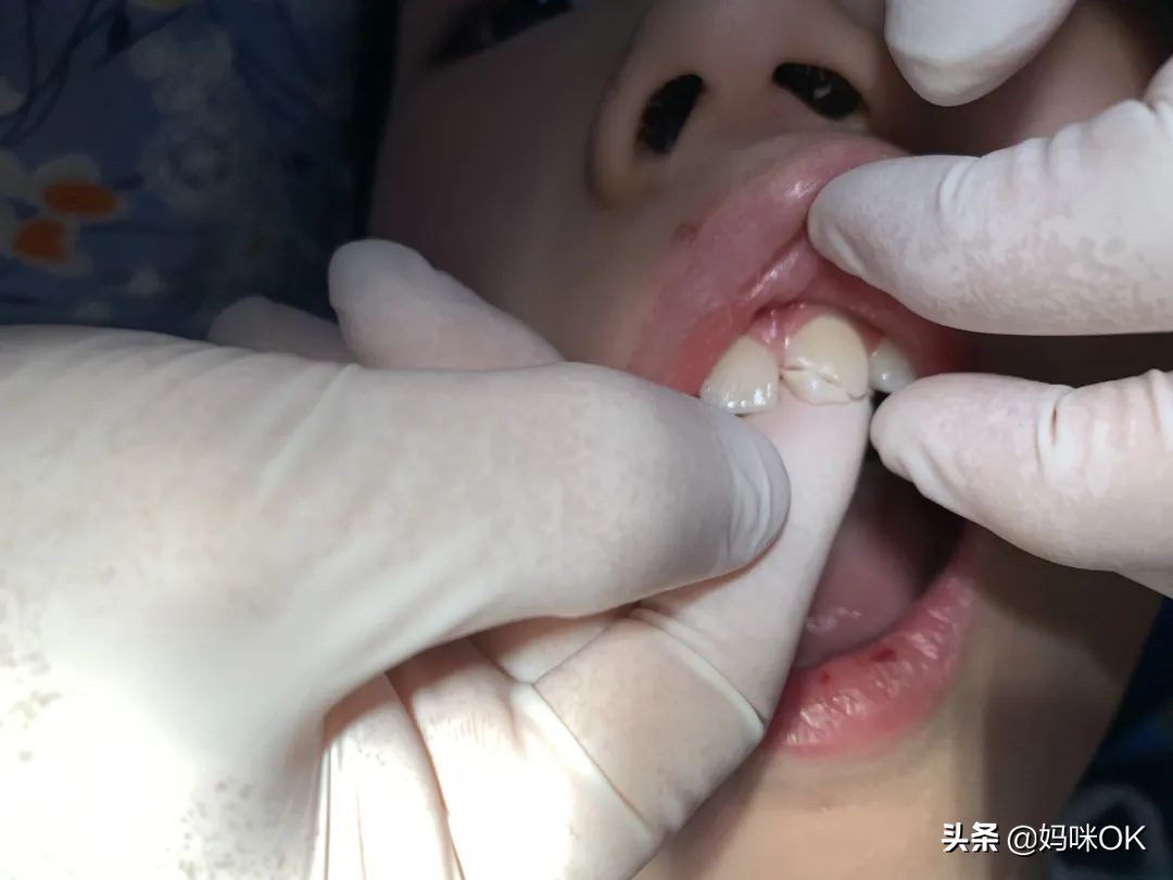 18岁前不能再用门牙吃东西！儿子的这一跤摔得有点惨痛