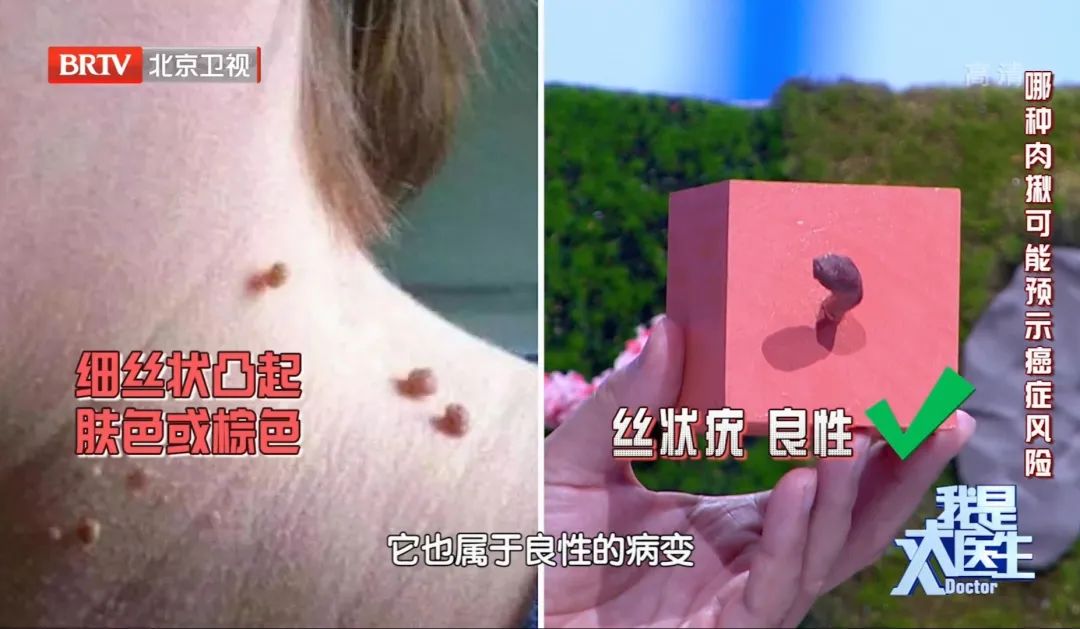 皮肤上的小肉疙瘩能自己弄下来吗,皮肤抠烂的硬疙瘩不好咋办