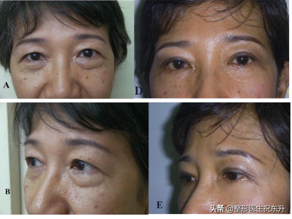 有眼袋之后感觉自己很丑,有眼袋好难看怎么办