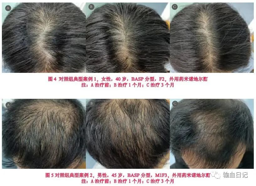 富血小板血浆治疗骨质增生吗,富血小板治疗脂溢性脱发