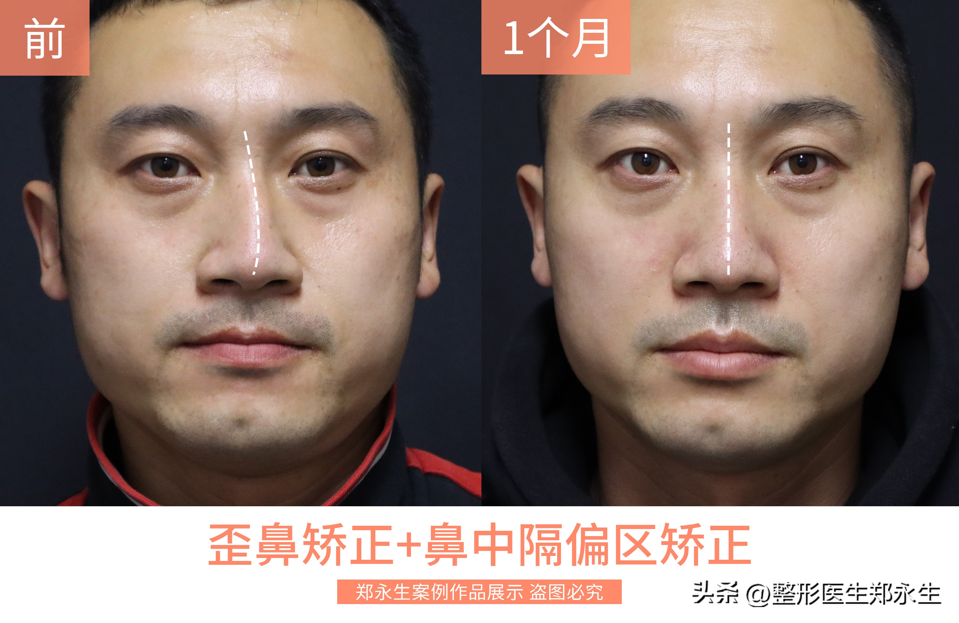 歪鼻是什么原因引起的,歪鼻歪鼻