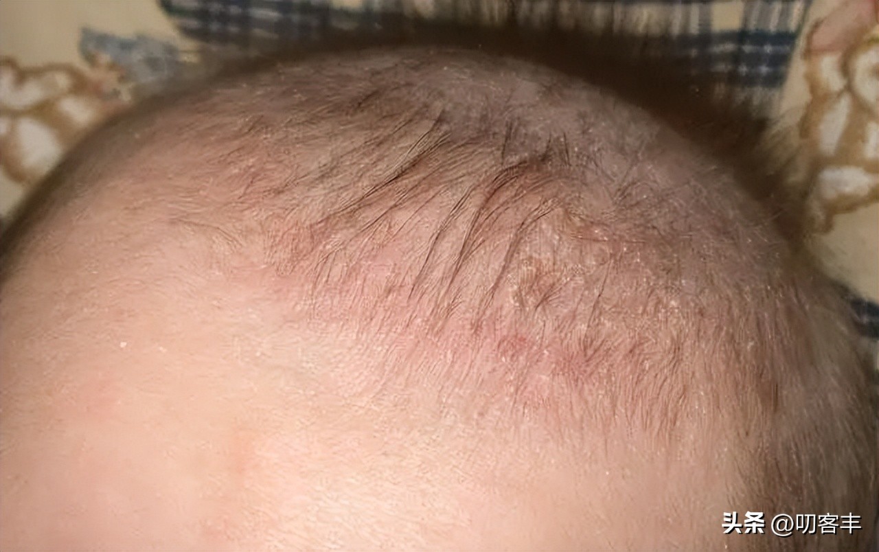 婴儿脂溢性皮炎和头垢的区别,婴儿脂溢性皮炎干燥脱皮怎么办