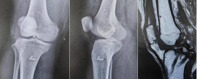 微创小切口治疗,医院的小微创手术都有什么